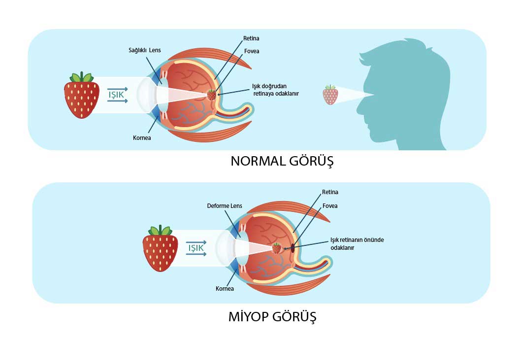 miyop nedir